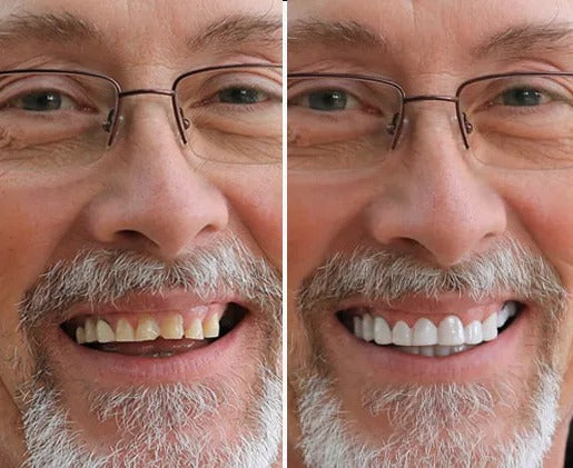 SmileLuxe™ Snap-On Veneers