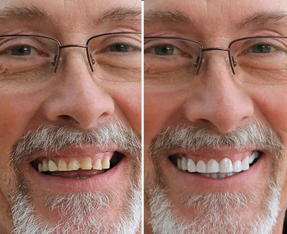 SmileLuxe™ Snap-On Veneers