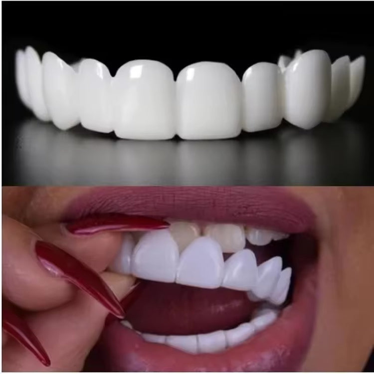 SmileLuxe™ Snap-On Veneers