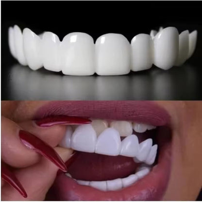 SmileLuxe™ Snap-On Veneers